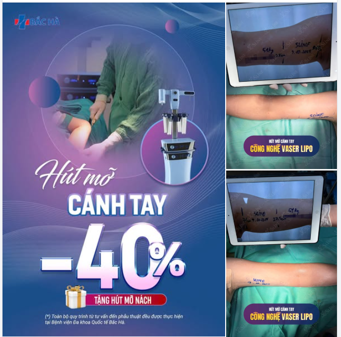 HÚT MỠ CÁNH TAY – GIẢM 40% TRONG THÁNG 10.