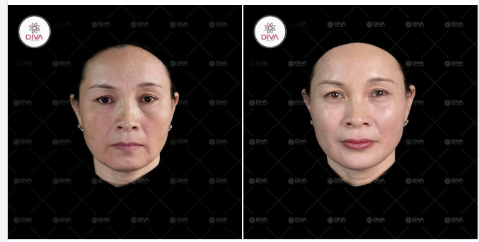 THỰC HIỆN MD CODES VỚI SỐ LƯỢNG FILLER NHIỀU THÌ CÓ LÀM MẶT BỊ PHÌNH TO RA KHÔNG?