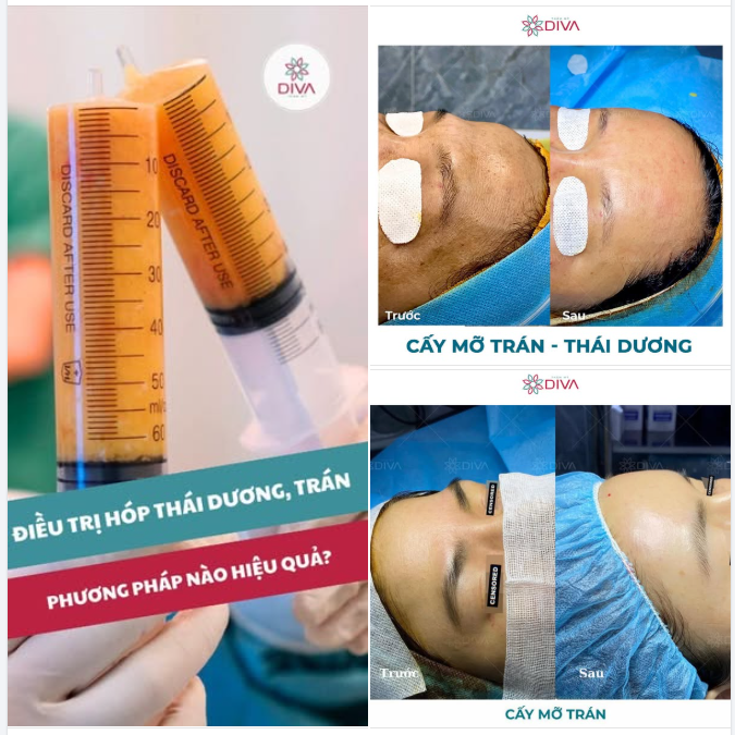 CẤY MỠ TRÁN - PP ĐIỀU CHỈNH NHẸ NHÀNG NHƯNG HIỆU QUẢ LỚN