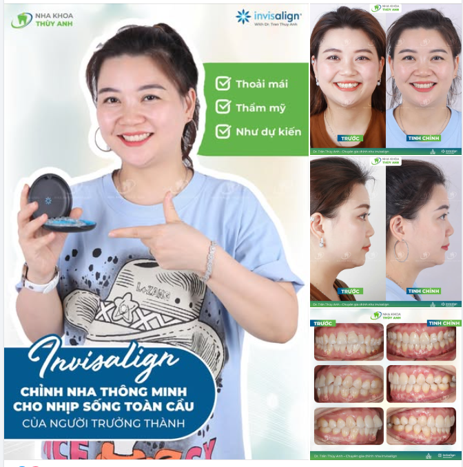 HÀNH TRÌNH CHỈNH NHA KHÔNG KHOẢNG CÁCH VỚI INVISALIGN