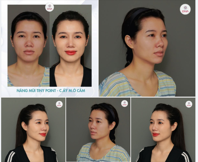 GƯƠNG MẶT TRỞ NÊN TƯƠI TẮN TỰ TIN HƠN NHỜ COMBO CẤY MỠ CẰM - NÂNG MŨI TINY POINT!