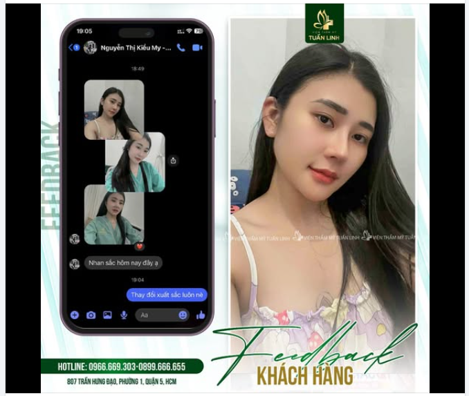 Feedback nâng mũi - Dáng mũi sau 20 ngày - Đẹp tự nhiên mà cực kỳ thanh tú, cuốn hút.