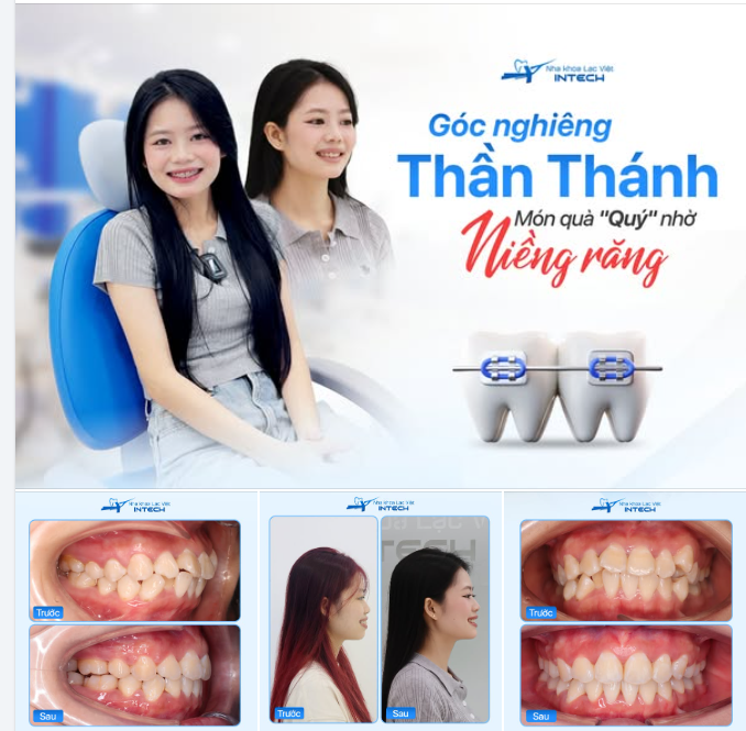 "RĂNG ĐỀU CƯỜI XINH HƠN RĂNG DUYÊN" - HÀNH TRÌNH UNLOCK GÓC NGHIÊNG NHỜ NIỀNG RĂNG