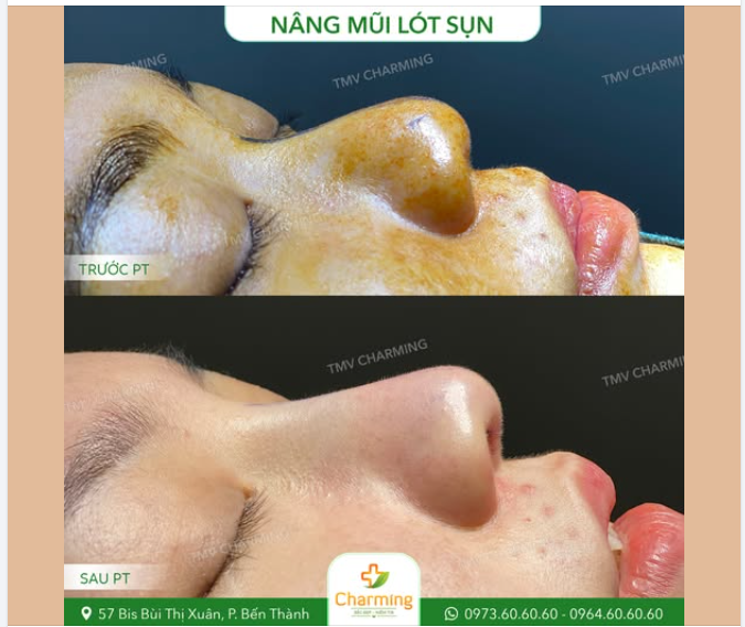 Ban đầu, dáng mũi của nàng khách khá khiêm tốn, chưa tạo điểm nhấn cho gương mặt.