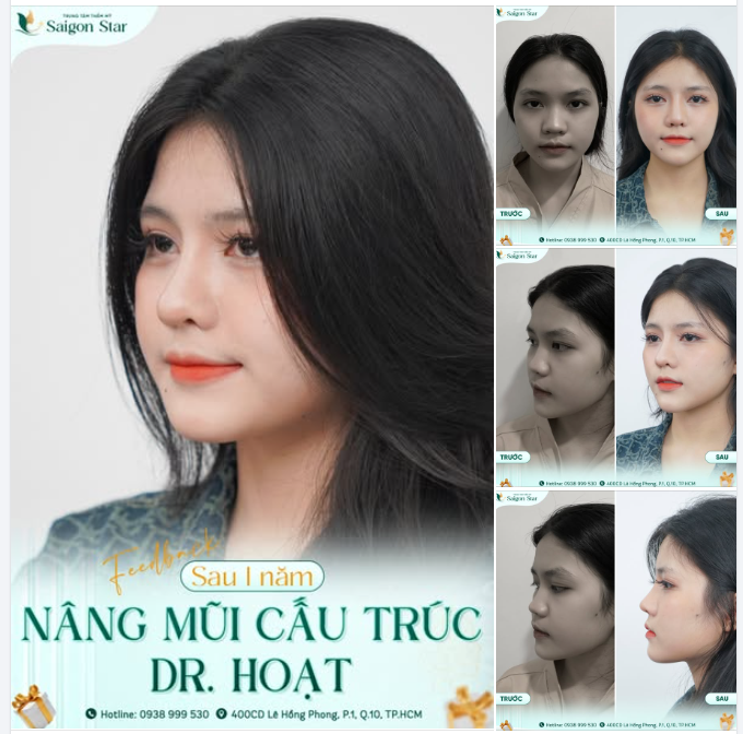 FEEDBACK SAU 1 NĂM - NÂNG MŨI CẤU TRÚC TẠI SAIGON STAR
