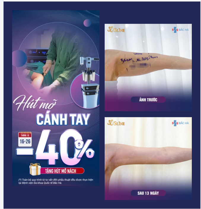 BÙNG NỔ NGÀY VÀNG – HÚT MỠ CÁNH TAY GIẢM SỐC