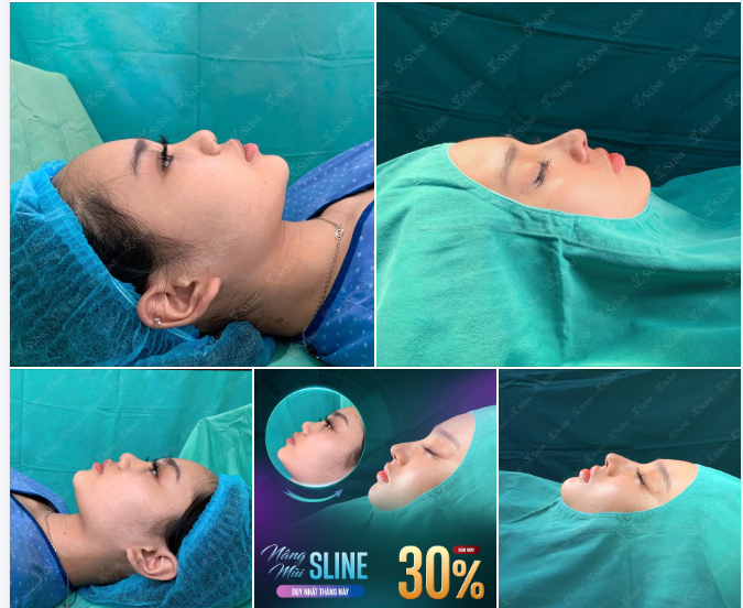 NÂNG MŨI SLINE – TÔN DÁNG MŨI, HÀI HÒA GƯƠNG MẶT.