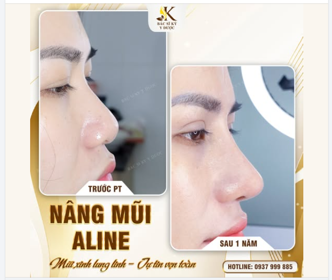 Mũi xinh lung linh – Tự tin vẹn toàn