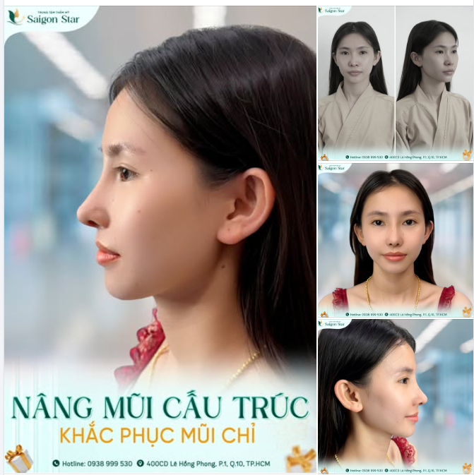 Nâng mũi cấu trúc – Giải pháp khắc phục mũi hỏng do nâng mũi chỉ