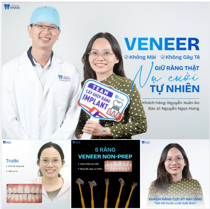 Khe thưa răng cửa không còn là nỗi lo với RĂNG SỨ VENEER Không mài - Không gây tê!