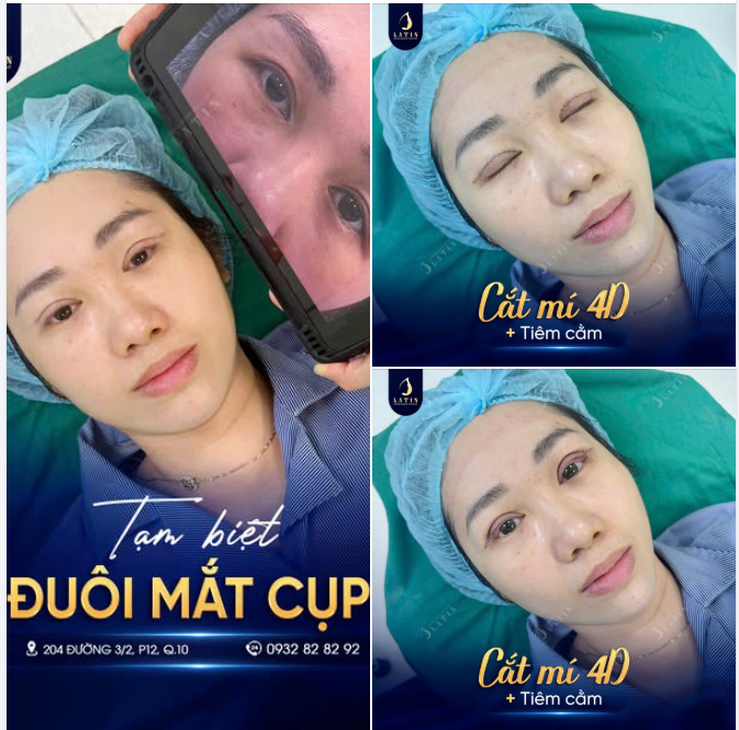 Tạm biệt đuôi mắt cụp – Đón ánh nhìn rạng ngời
