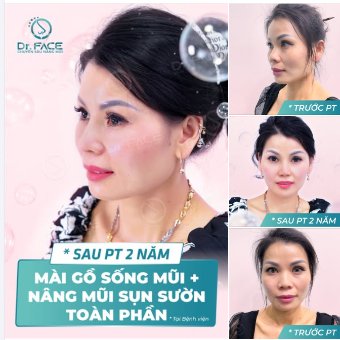 HAI NĂM TRÔI QUA, CHIẾC MŨI CÒN ĐẸP HƠN NGÀY ĐẦU