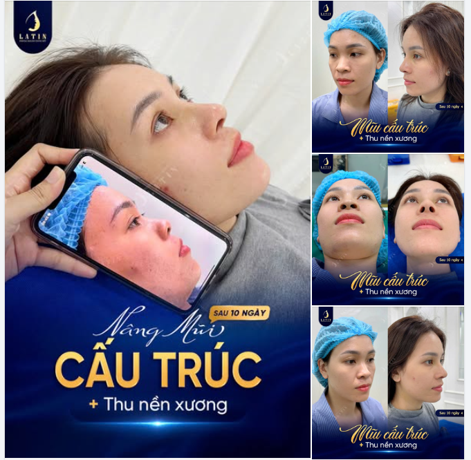 MŨI RỘNG BỀ NGANG SANG CAO BỀ DỌC BẰNG THU NỀN XƯƠNG