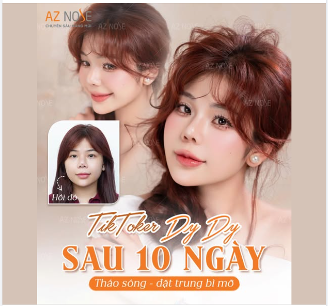 Dáng mũi của TikToker Dy Dy cải thiện rõ rệt sau 10 ngày tháo sóng – đặt trung bì mỡ
