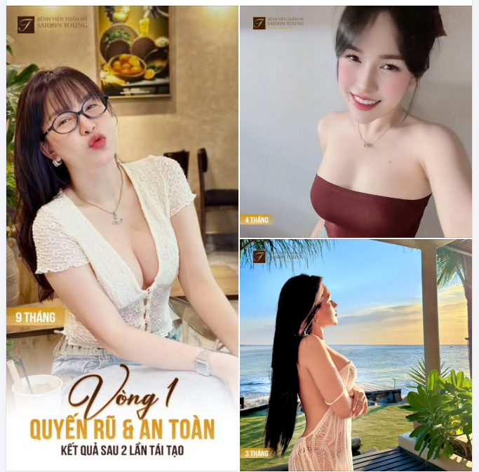 KHẮC PHỤC NHƯỢC ĐIỂM CŨ - SỞ HỮU DÁNG V1 ĐẸP NHƯ MƠ