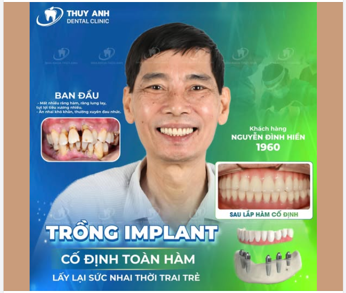 RĂNG THẬT VẪN CÒN RẤT NHIỀU NHƯNG LẠI NHỔ HẾT ĐỂ TRỒNG TOÀN HÀM?