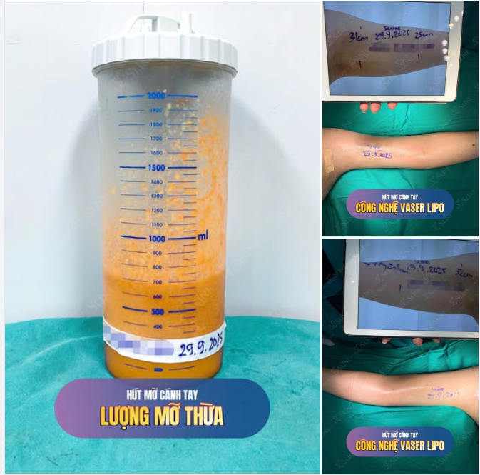 HÚT MỠ CÁNH TAY – CÁNH TAY THON GỌN, TỰ TIN DIỆN MỌI TRANG PHỤC