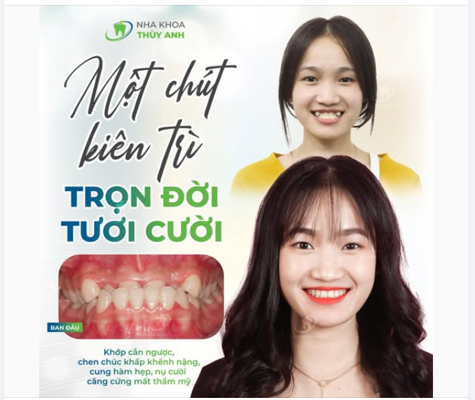 NIỀNG RĂNG GIÚP BẠN LẤY LẠI NỤ CƯỜI TỰ TIN NHƯ THẾ NÀO?