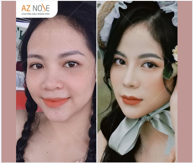 Chỉ từ 21tr - sở hữu dáng mũi mới khiến bạn tự tin và tỏa sáng.  Đừng bỏ lỡ những ưu đãi cho mùa lễ hội từ AZNOSE!