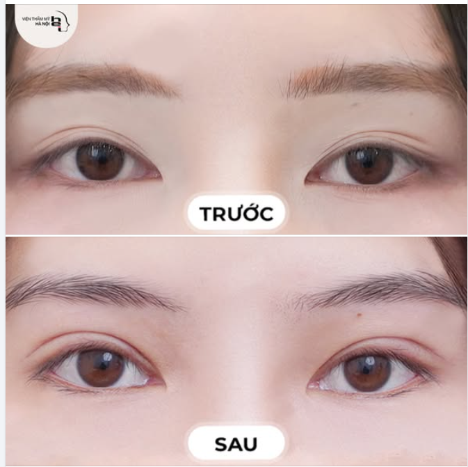 NHẤN MÍ OVAL LINE WIDE DEEP  Đôi mắt sắc sảo – Đẹp không tì vết