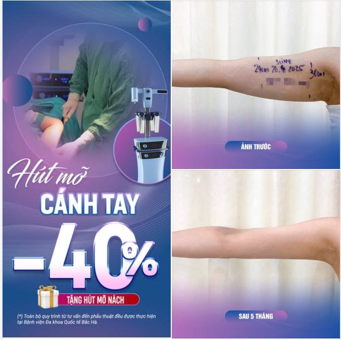 HÚT MỠ CÁNH TAY  "Giải pháp cho vẻ đẹp thon gọn"