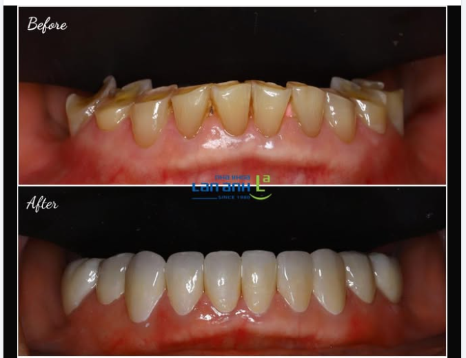 Răng sứ đẹp, là phải đẹp từ hình dạng, màu sắc răng, độ cứng phù hợp với lực ăn nhai của từng người khác nhau ạ