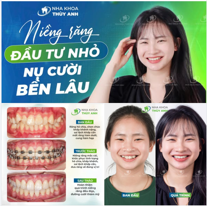 BÍ QUYẾT CHỈNH RĂNG KHẤP KHỂNH ĐỂ TỰ TIN KHOE NỤ CƯỜI RẠNG RỠ