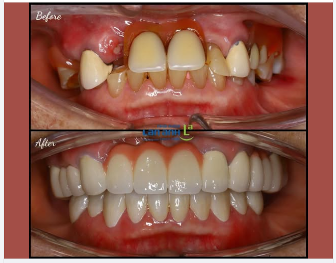 Có thể răng bạn hiện tại chưa được đẹp lắm… nhưng sau khi làm lại thì sẽ cải thiện rất nhiều ạ