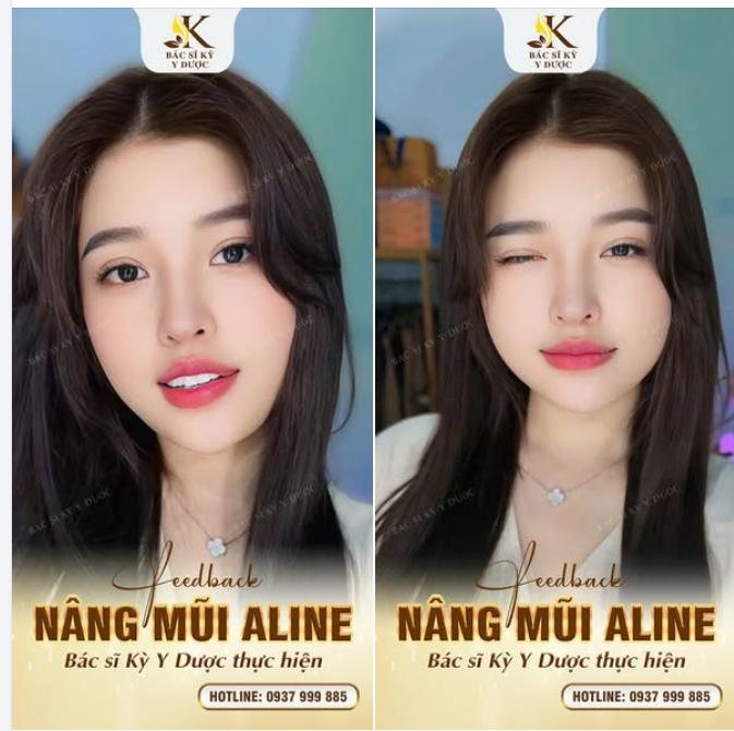 Feedback Nâng Mũi ALINE Chính tay Bác sĩ Kỳ Y Dược thực hiện