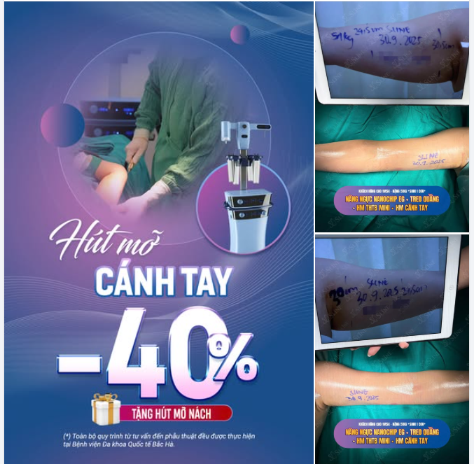 HÚT MỠ CÁNH TAY – ƯU ĐÃI THÁNG 10 CỰC SỐC