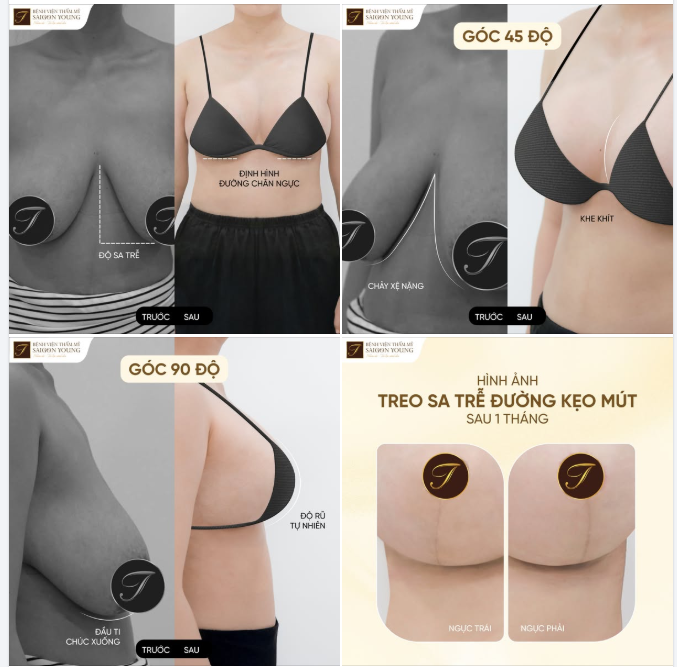 Mẹ 3 con sở hữu vòng 1 mỹ mãn sau 1 tháng treo sa trễ