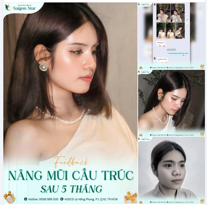 GỬI CHỊ EM CHIẾC FEEDBACK SIÊU THỰC SAU 5 THÁNG NÂNG MŨI CẤU TRÚC