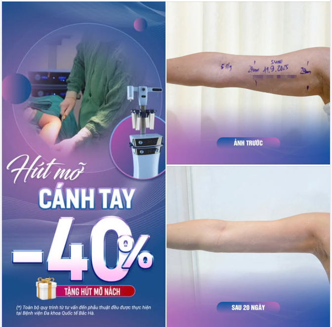 GỌN DÁNG TAY – DIỆN GÌ CŨNG ĐẸP