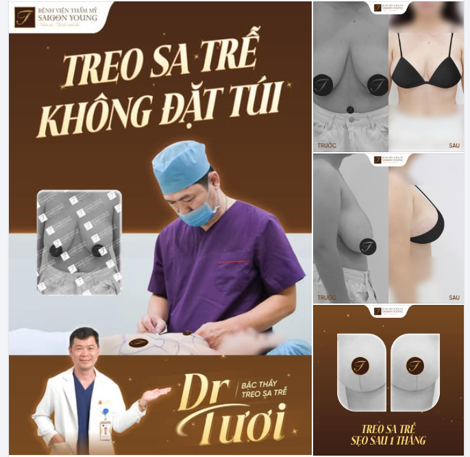 TREO SA TRỄ KHÔNG ĐẶT TÚI - Dành cho chị em chảy xệ V1 sau sinh nhưng có nhiều mô tuyến