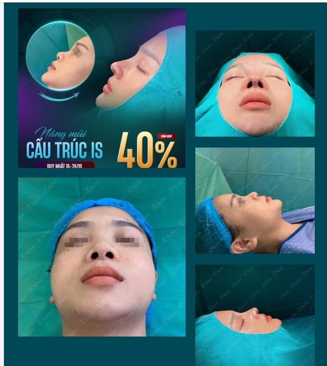 NÂNG MŨI – NÂNG TẦM NHAN SẮC