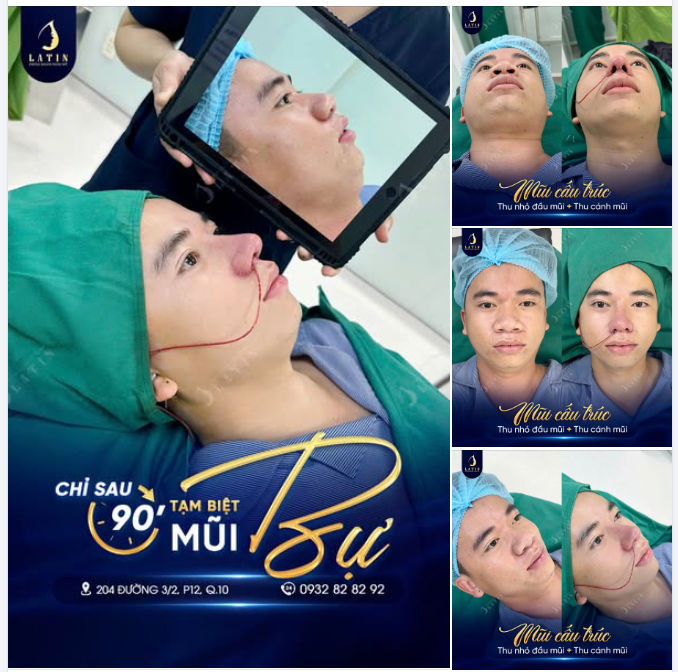 MŨI GỌN GÀNG HƠN CHO THẦN THÁI NAM TÍNH, PHONG ĐỘ