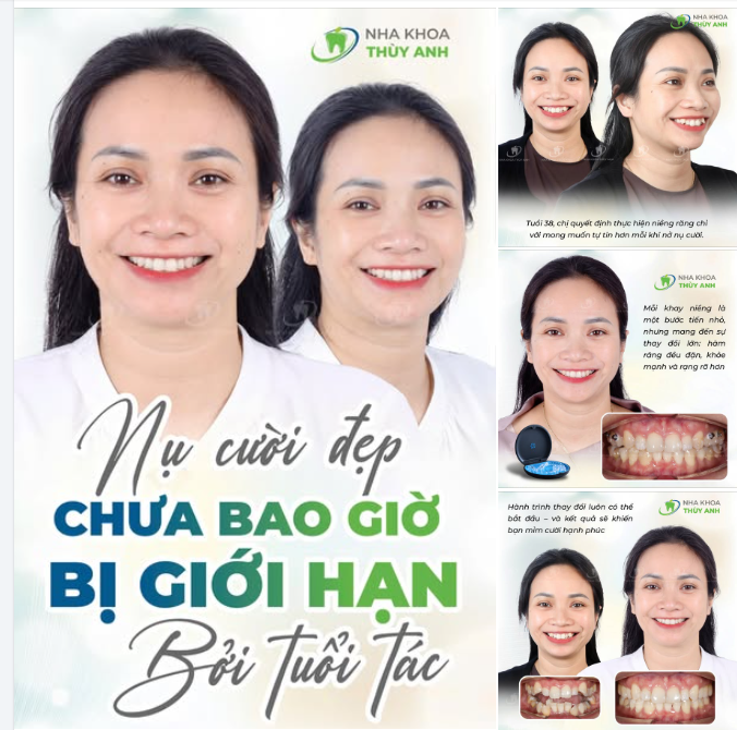 NỤ CƯỜI ĐẸP CHƯA BAO GIỜ BỊ GIỚI HẠN VỀ TUỔI TÁC VỚI INVISALIGN