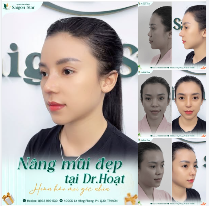 CÁI KẾT "SIÊU ƯNG BỤNG" SAU KHI LÀM THEO BẠN ĐI NÂNG MŨI TẠI DR.HOẠT