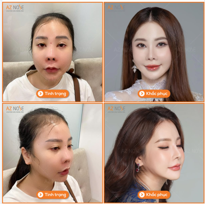 “Thời điểm đó mình không dám ra đường, nhiều lúc stress quá còn ng.hĩ qu.ẩn...”