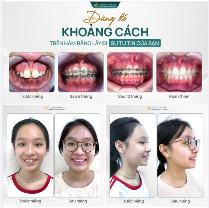 Đừng để khoảng cách trên răng lấy đi sự tự tin của bạn