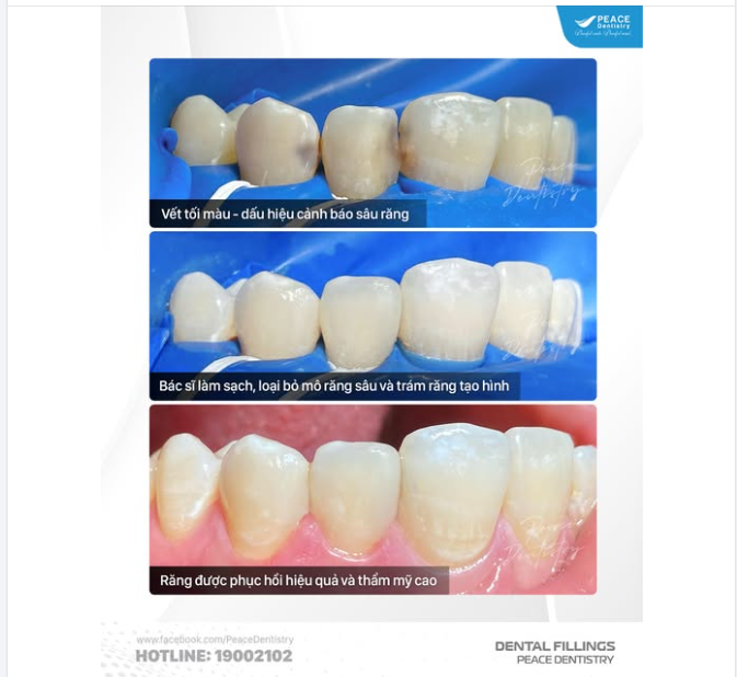VẾT TỐI MÀU GIỮA KẼ RĂNG: Một vấn đề răng miệng phổ biến nhưng thường bị bỏ qua.