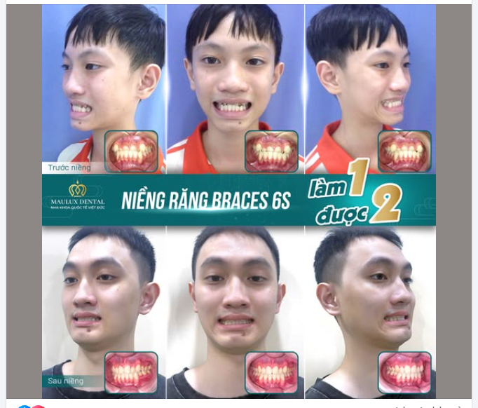 MỪNG NGÀY THÁO NIỀNG – NỤ CƯỜI TỰ TIN CỦA AN