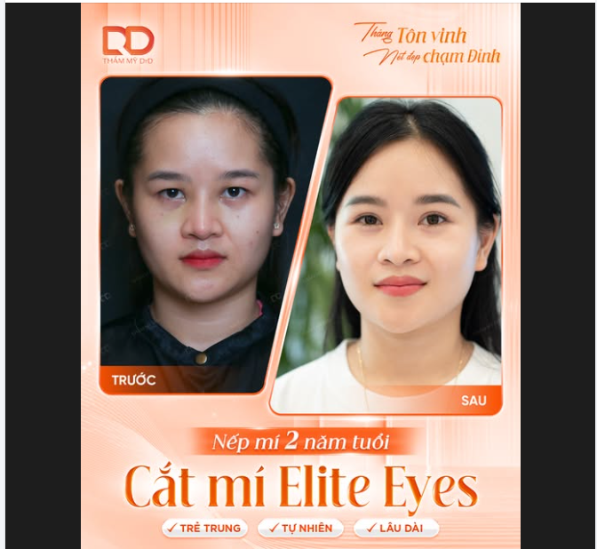 Nếp mí 2 năm tuổi – Đẹp tự nhiên, trẻ trung như ngày đầu