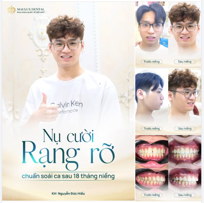 NIỀNG RĂNG - HÀNH TRANG CHO TƯƠNG LAI CỦA HIẾU