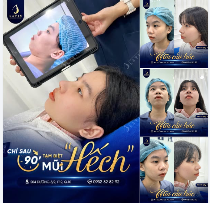 10 NGÀY SAU NÂNG MŨI – TẠM BIỆT MŨI HẾCH, CHÀO DÁNG MŨI TỰ NHIÊN HỢP MẶT