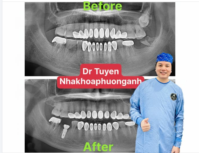 9 lợi ích của việc cấy ghép Implant