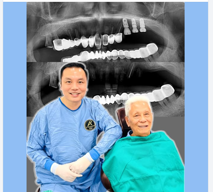 Implant Nha Khoa Có Bền Không?
