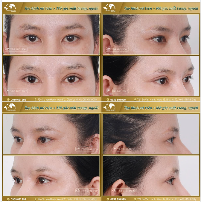 Hiệu quả sau combo ph.ẫu th.uật mí mắt trên, mở góc mắt giúp khắc phục khiếm khuyết nếp mí mắt nhỏ, hẹp cho quý Cô 9X.