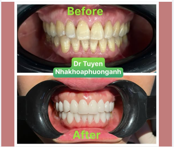 Bọc răng sứ giữ được bao lâu và hướng dẫn chăm sóc sau bọc răng