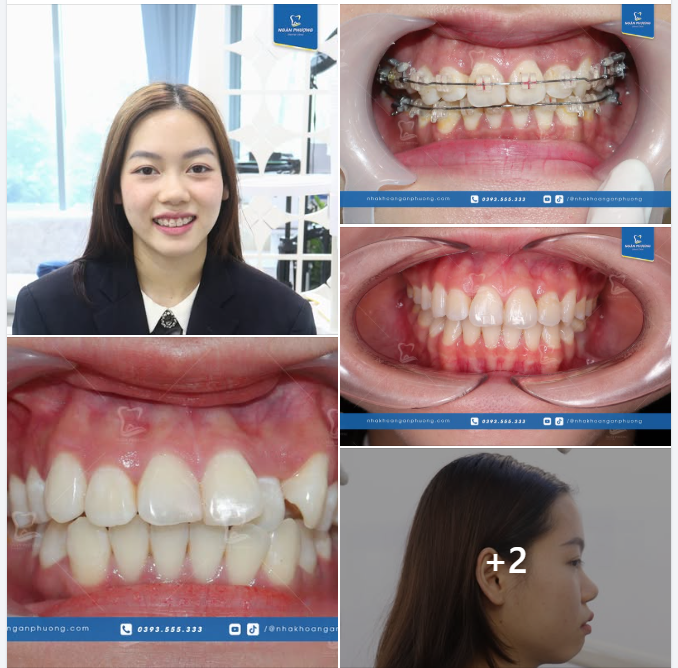 Hỡi nàng răng gắn mắc cài  Muốn răng đều đẹp, sớm mai kiên trì